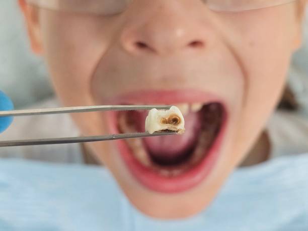 Best Emergency Dental Care for Abscessed Tooth in Estill Springs, TN